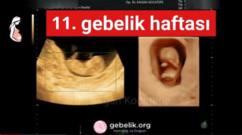 ikiz gebelikte 10 hafta görüntüleri